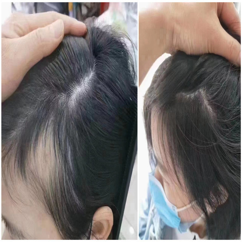 Exosome Therapy vs. PRP: Which Offers Superior Outcomes for Hair Loss?